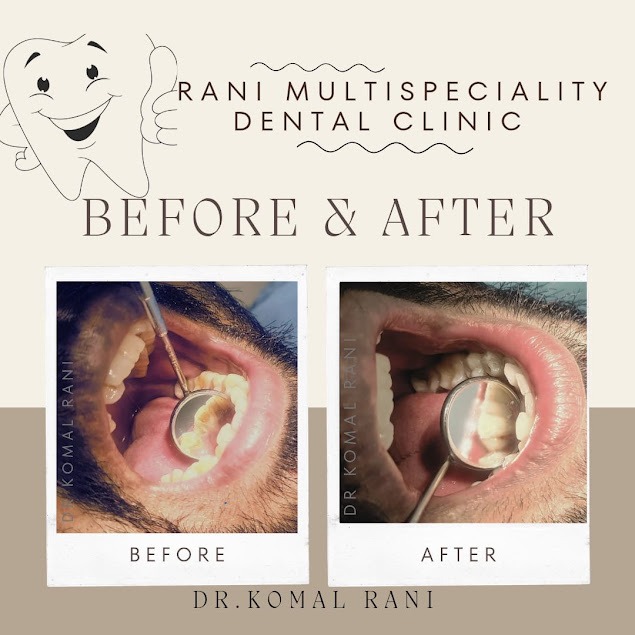 Teeth Scaling Before & After - Rani Dental Clinic